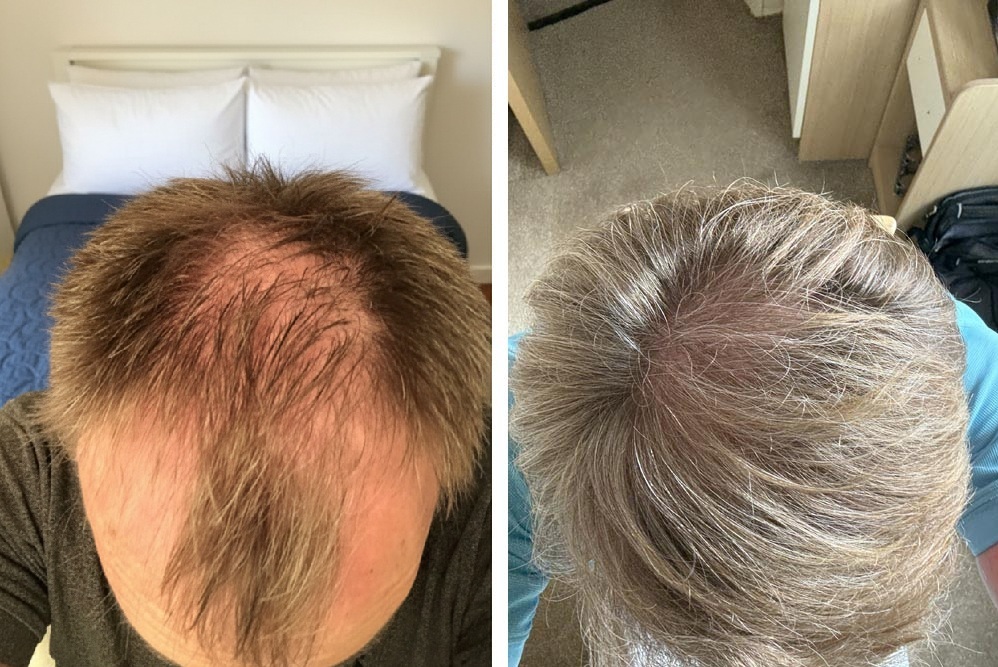 High-End Hair Transplant in Turkey