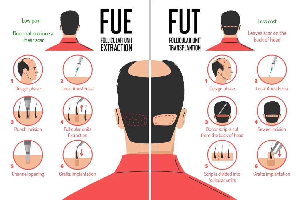 FUE vs FUT Hair Transplant: Which One Is Right for You?