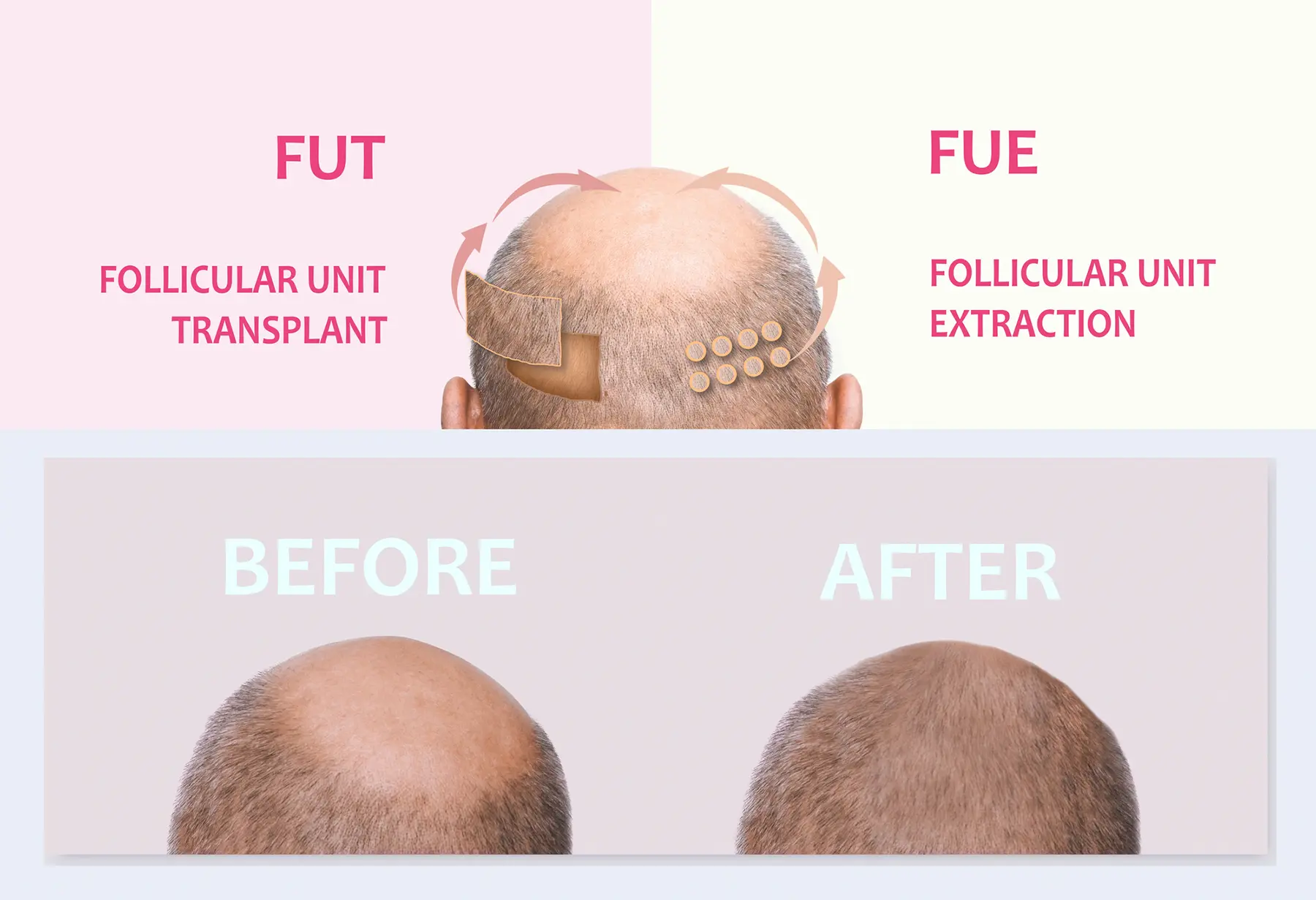 FUE vs FUT Hair Transplant: Which One Is Right for You?