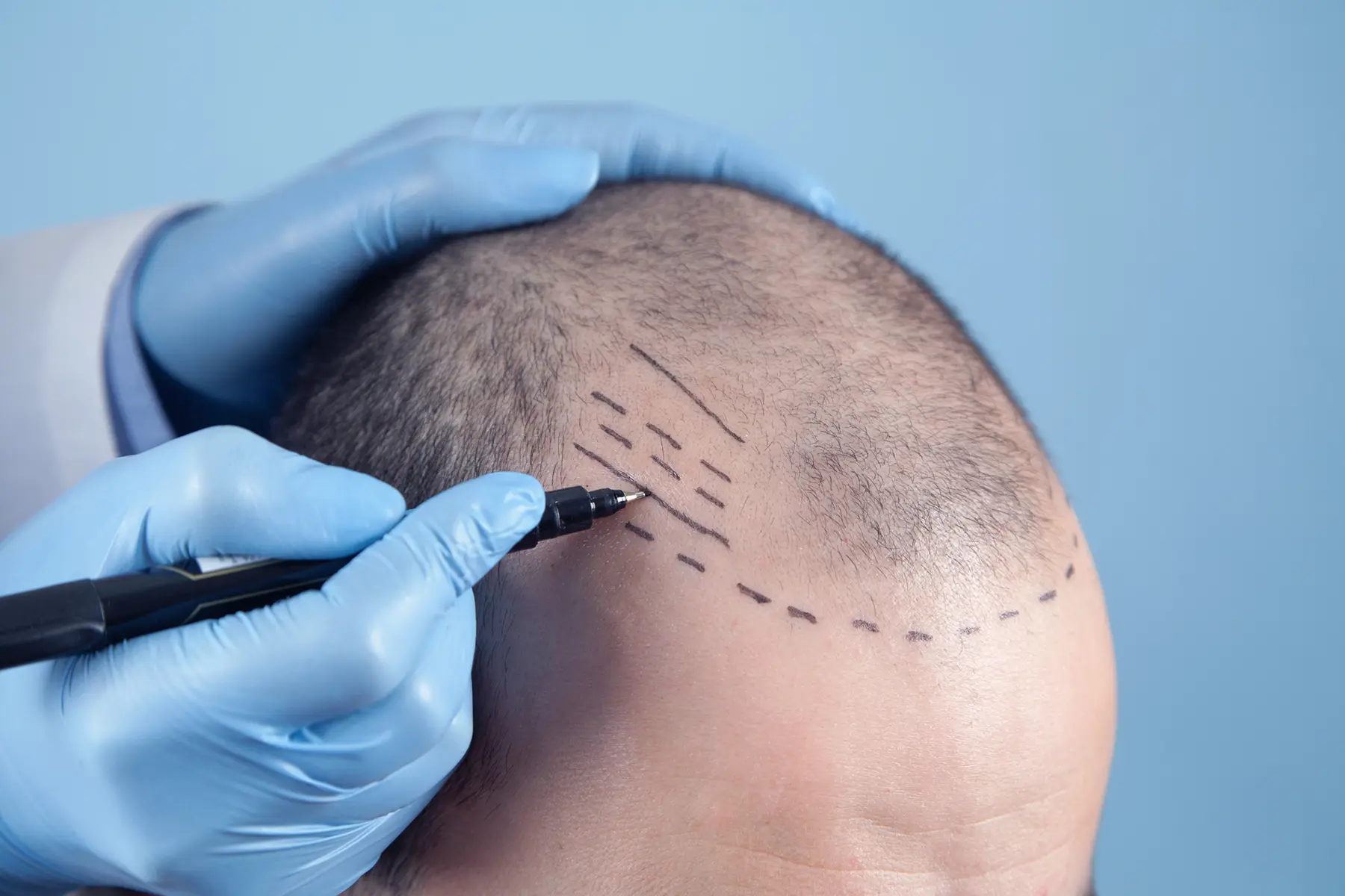 Hair Transplant Cost Ireland vs Turkey: What to Know